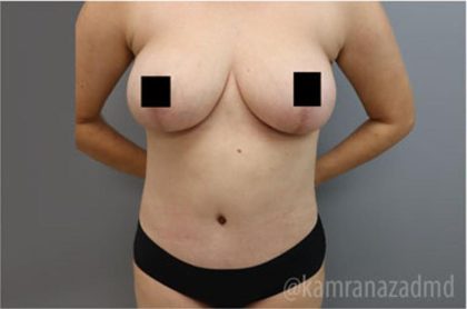 Mommy Makeover Before & After Patient #2916