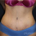Tummy Tuck Before & After Patient #2833