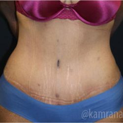 Tummy Tuck Before & After Patient #2833