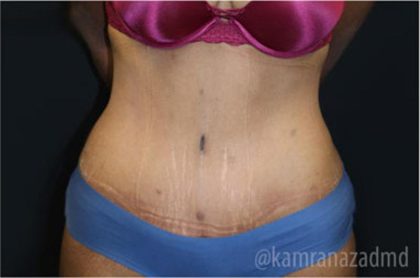 Tummy Tuck Before & After Patient #2833