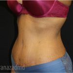 Tummy Tuck Before & After Patient #2833