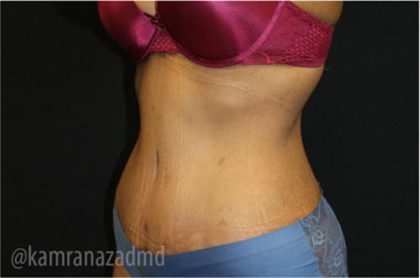 Tummy Tuck Before & After Patient #2833