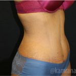 Tummy Tuck Before & After Patient #2833