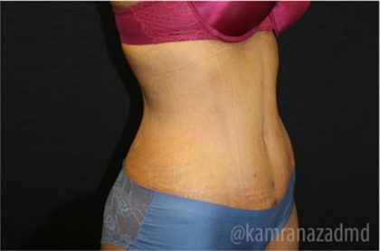 Tummy Tuck Before & After Patient #2833