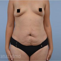 Tummy Tuck Before & After Patient #2834