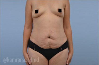 Tummy Tuck Before & After Patient #2834