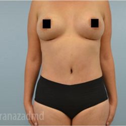 Tummy Tuck Before & After Patient #2834