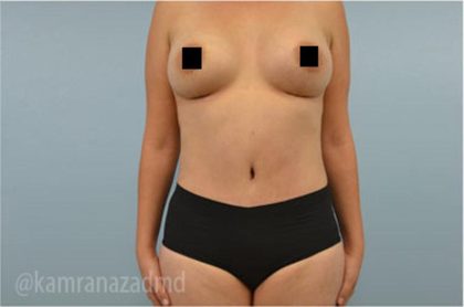 Tummy Tuck Before & After Patient #2834