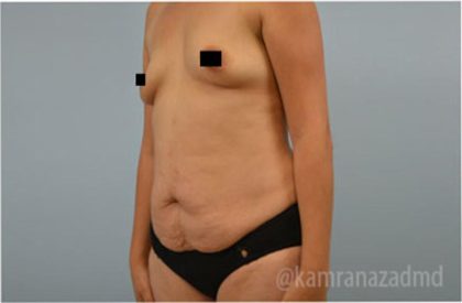 Tummy Tuck Before & After Patient #2834