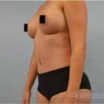 Tummy Tuck Before & After Patient #2834