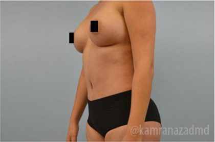 Tummy Tuck Before & After Patient #2834