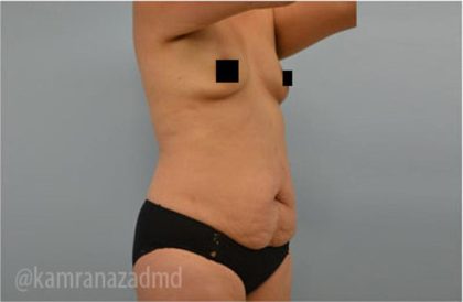 Tummy Tuck Before & After Patient #2834