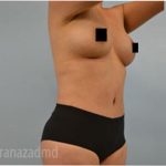 Tummy Tuck Before & After Patient #2834