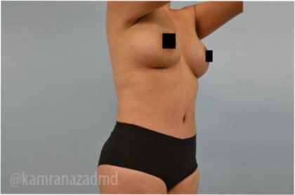 Tummy Tuck Before & After Patient #2834