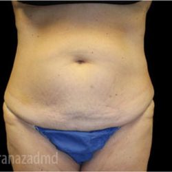 Tummy Tuck Before & After Patient #2835