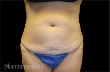 Tummy Tuck Before & After Patient #2835