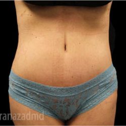 Tummy Tuck Before & After Patient #2835