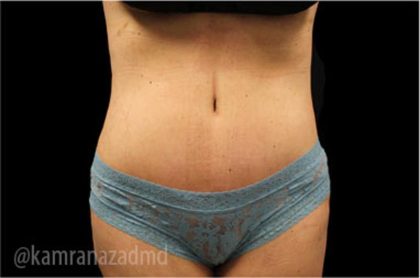 Tummy Tuck Before & After Patient #2835