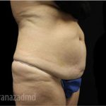 Tummy Tuck Before & After Patient #2835