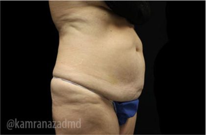 Tummy Tuck Before & After Patient #2835