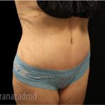 Tummy Tuck Before & After Patient #2835