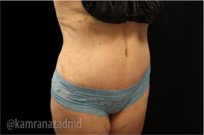 Tummy Tuck Before & After Patient #2835