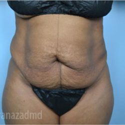 Tummy Tuck Before & After Patient #2871