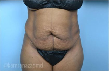 Tummy Tuck Before & After Patient #2871