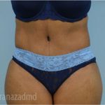 Tummy Tuck Before & After Patient #2871