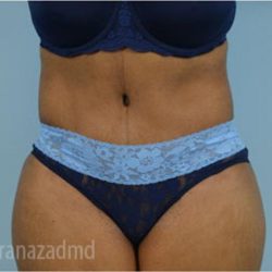 Tummy Tuck Before & After Patient #2871