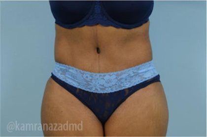 Tummy Tuck Before & After Patient #2871