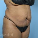 Tummy Tuck Before & After Patient #2871