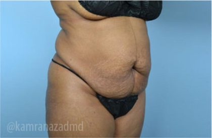 Tummy Tuck Before & After Patient #2871