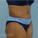 Tummy Tuck Before & After Patient #2871