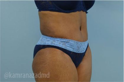 Tummy Tuck Before & After Patient #2871
