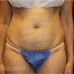 Tummy Tuck Before & After Patient #2837