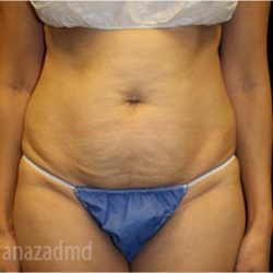 Tummy Tuck Before & After Patient #2837