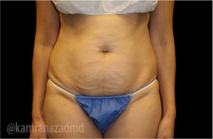Tummy Tuck Before & After Patient #2837