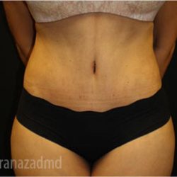 Tummy Tuck Before & After Patient #2837