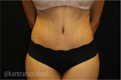 Tummy Tuck Before & After Patient #2837