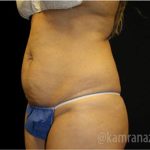 Tummy Tuck Before & After Patient #2837
