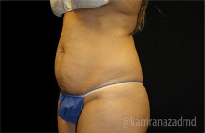 Tummy Tuck Before & After Patient #2837