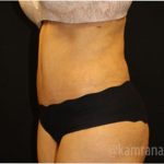 Tummy Tuck Before & After Patient #2837