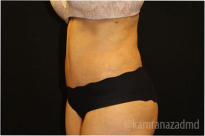 Tummy Tuck Before & After Patient #2837