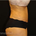 Tummy Tuck Before & After Patient #2837