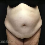Tummy Tuck Before & After Patient #2838