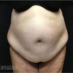 Tummy Tuck Before & After Patient #2838