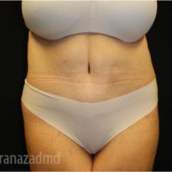 Tummy Tuck Before & After Patient #2838