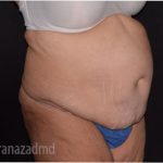 Tummy Tuck Before & After Patient #2838
