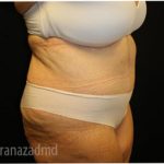 Tummy Tuck Before & After Patient #2838